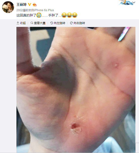 王丽坤五一拍戏手掌掉肉 素颜女神被曝曾整容
